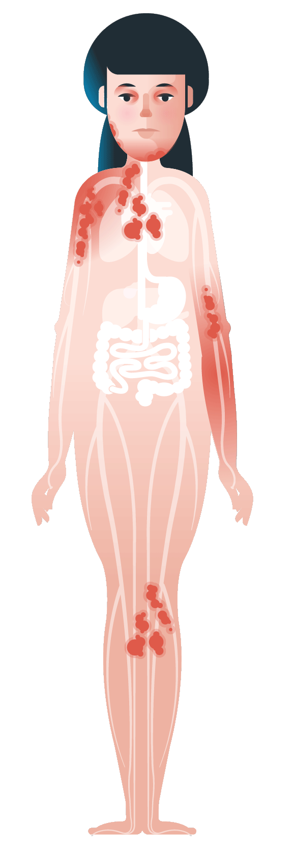 Anaphylaxis can affect the digestive system