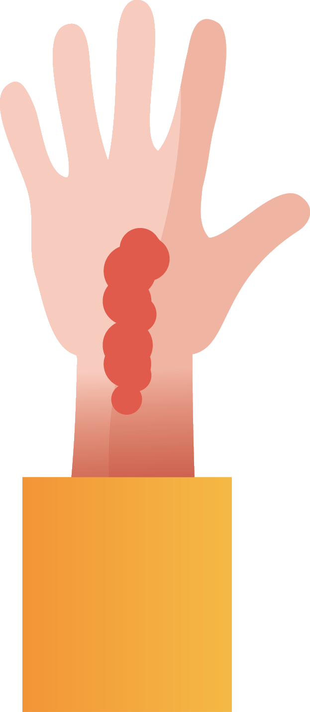 Anaphylaxis symptoms: hives