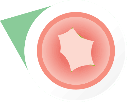 Swelling of throat during a severe allergic reaction