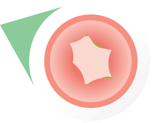 Swelling of throat during a severe allergic reaction
