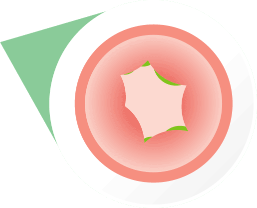 Swelling of throat during a severe allergic reaction