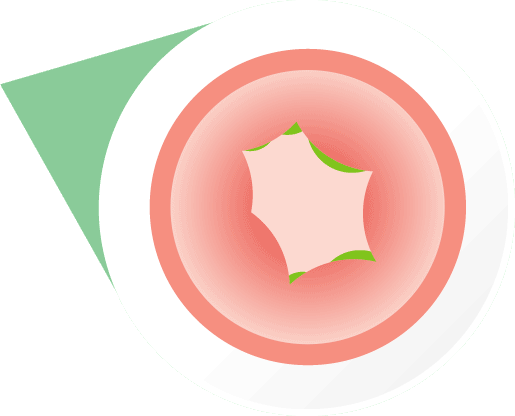Swelling of throat during a severe allergic reaction