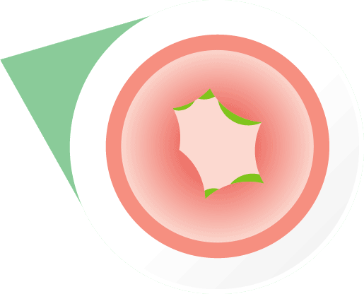 Swelling of throat during a severe allergic reaction