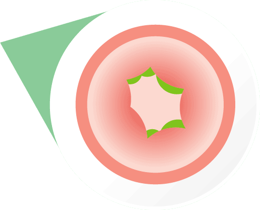 Swelling of throat during a severe allergic reaction