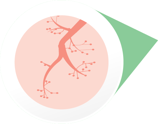 Airways tightening during a severe allergic reaction