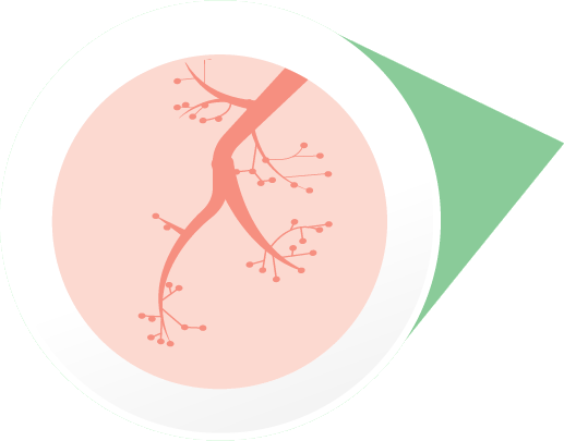 Airways tightening during a severe allergic reaction