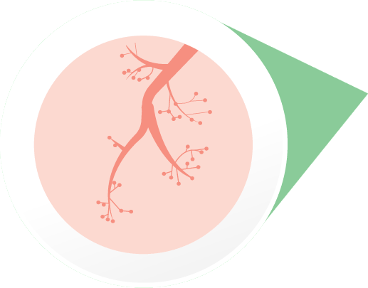Airways tightening during a severe allergic reaction