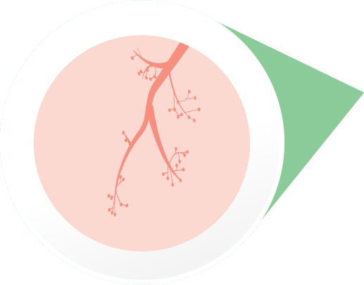 Airways tightening during a severe allergic reaction