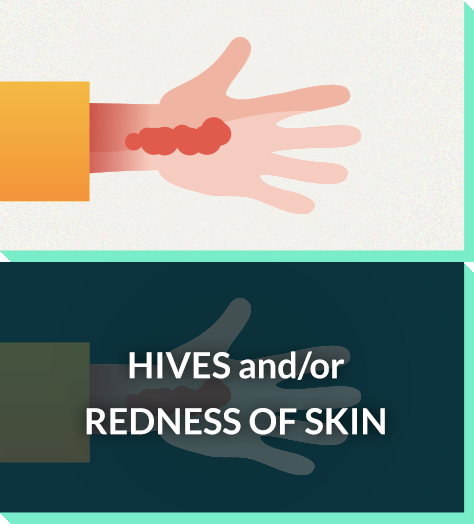 Severe allergy symptoms: hives, redness of skin