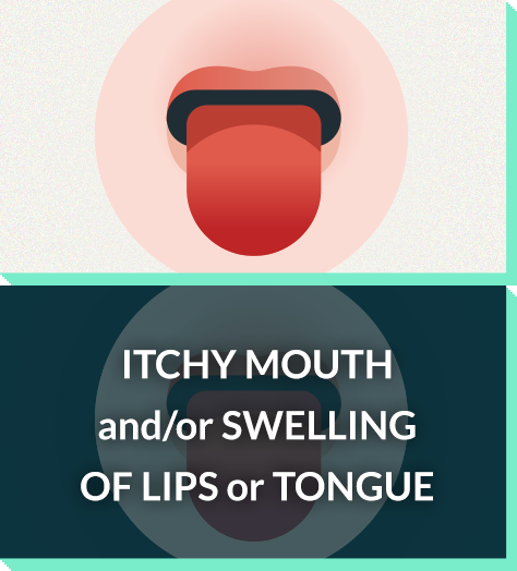 Severe allergy symptoms: itchy mouth, swelling of tongue or lips