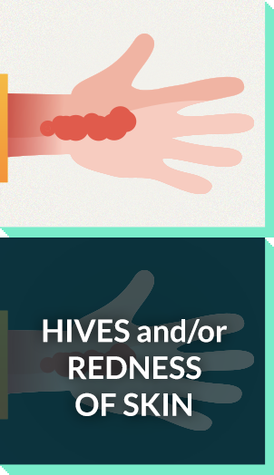 Severe allergy symptoms: hives, redness of skin