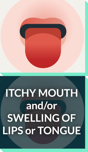 Severe allergy symptoms: itchy mouth, swelling of tongue or lips